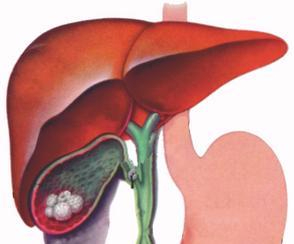 Холелитиаз