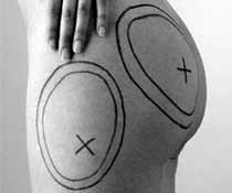 Липосакция - это просто?! Правильная липосакция