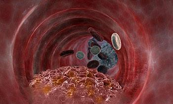 АТЕРОСКЛЕРОЗ