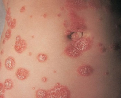 Лечение псориаза в домашних условиях