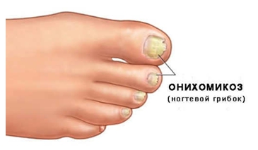 лечегие грибка лечение грибка