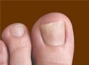 лечегие грибка лечение грибка