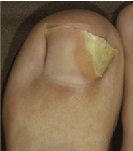 лечегие грибка лечение грибка