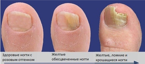 лечегие грибка лечение грибка