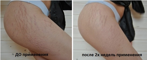 крем от растяжек крем от растяжек